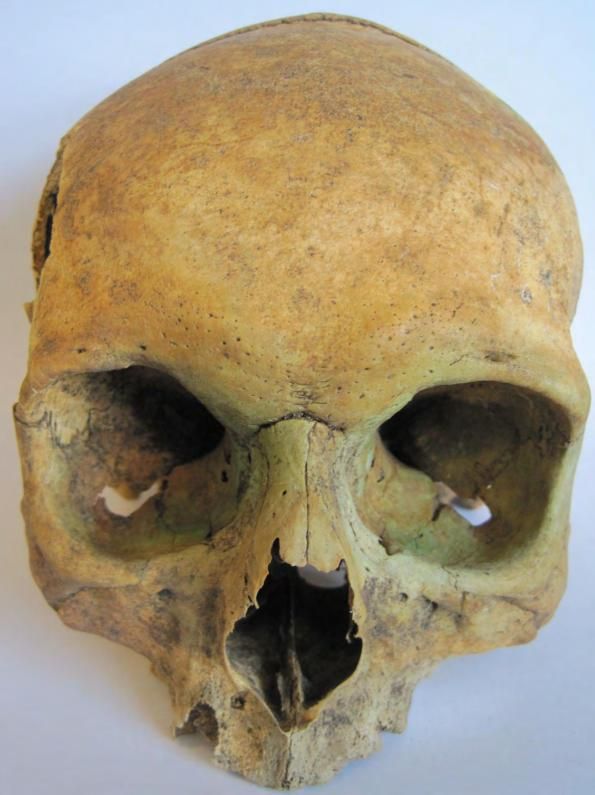 Schedel met koperoxidatie rond de ogen.