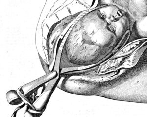 Eerste keizersnede in Zaanstreek in 1796